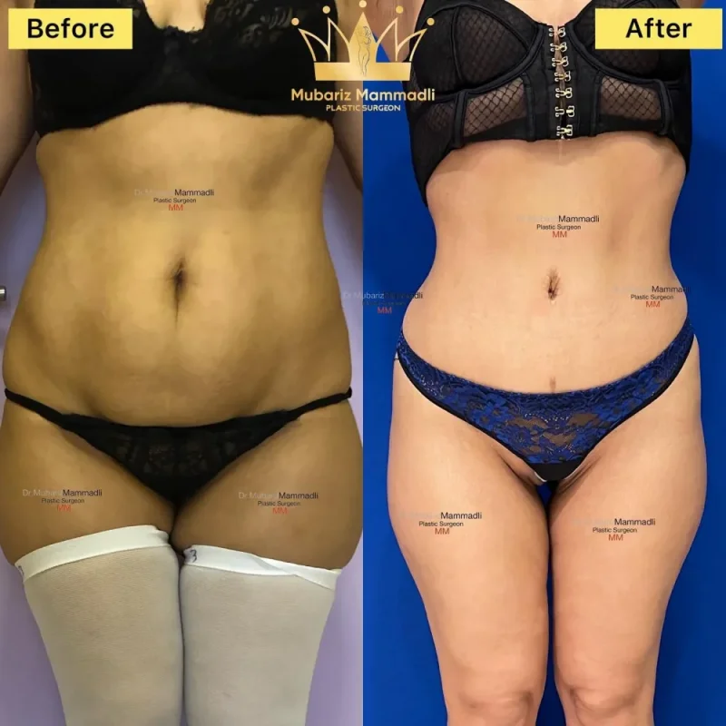 Abdominoplastika emeliyyati ; Abdominoplastika qiymeti ; Qarın gərmə əməliyyatı ;Reabilitasiya ;